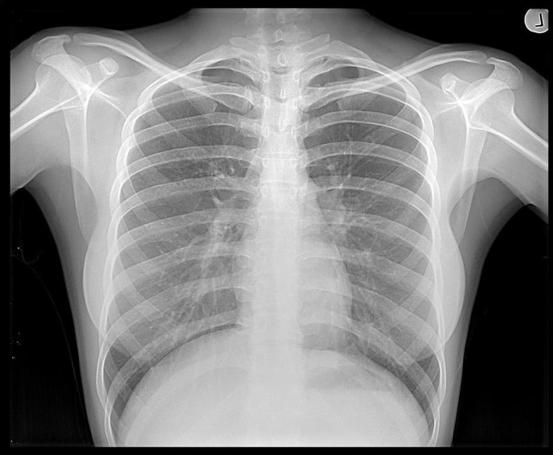 Chest X-Ray Image