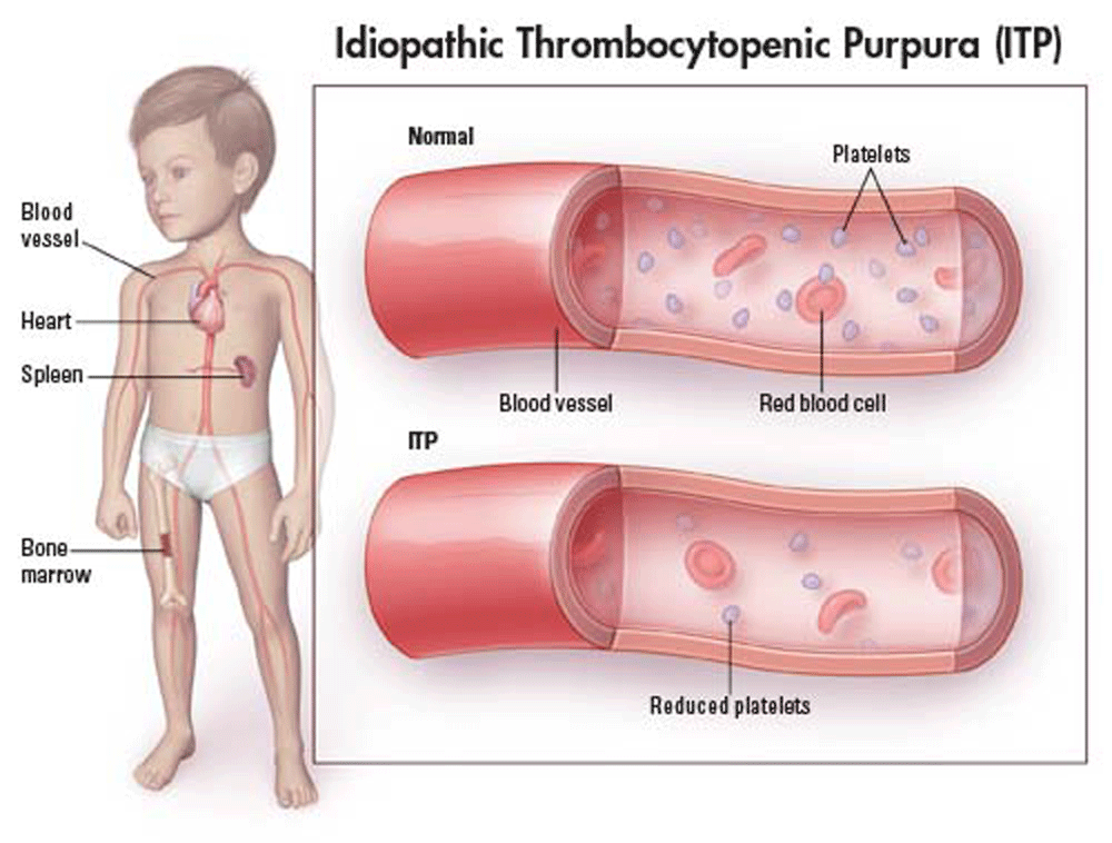 Idiopathic-Thrombocytopenic-Purpura