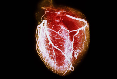 PRinc_rm_arteriogram_of_healthy_heart